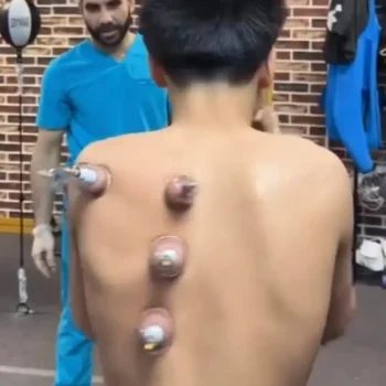 cupping therapy las vegas