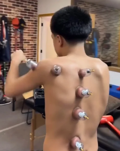 cupping therapy las vegas